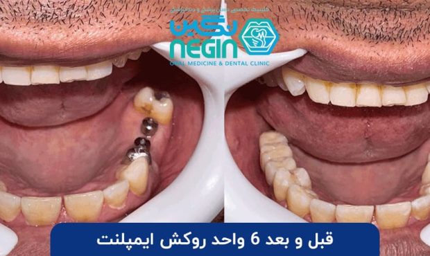راهنمای جامع انتخاب بهترین مرکز ایمپلنت دندان در شیراز: قیمت، اقساط و بهترین دکتر کاشت ایمپلنت